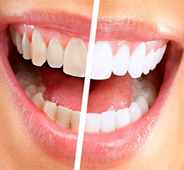 what not to eat after zoom teeth whitening